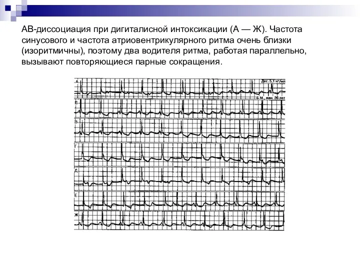 АВ-диссоциация при дигиталисной интоксикации (А — Ж). Частота синусового и частота атриовентрикулярного