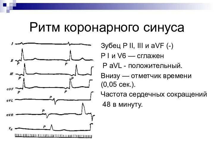 Ритм коронарного синуса Зубец Р II, III и aVF (-) Р I