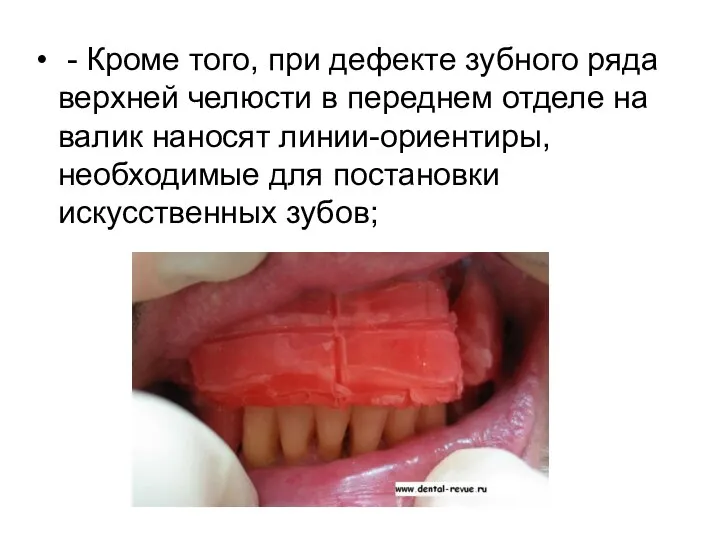 - Кроме того, при дефекте зубного ряда верхней челюсти в переднем отделе