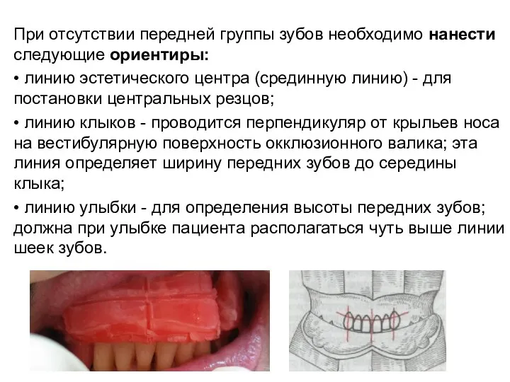 При отсутствии передней группы зубов необходимо нанести следующие ориентиры: • линию эстетического