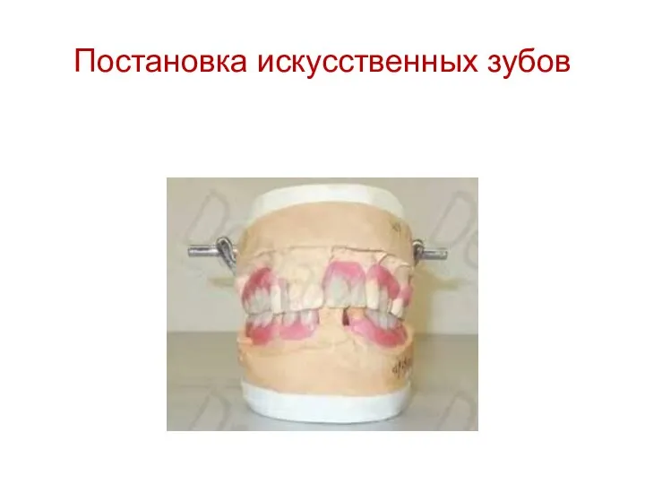 Постановка искусственных зубов
