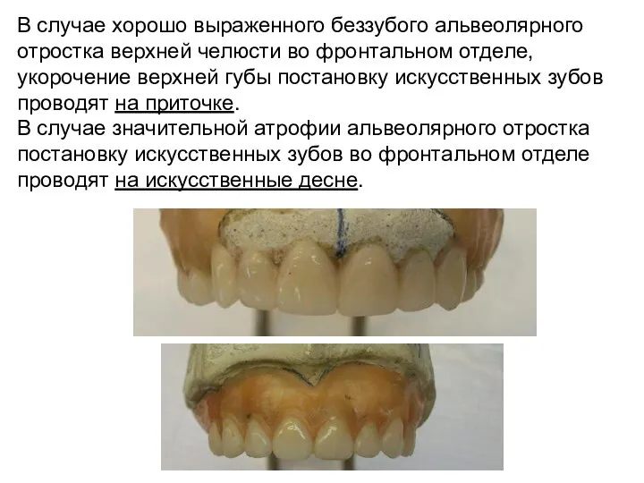 В случае хорошо выраженного беззубого альвеолярного отростка верхней челюсти во фронтальном отделе,