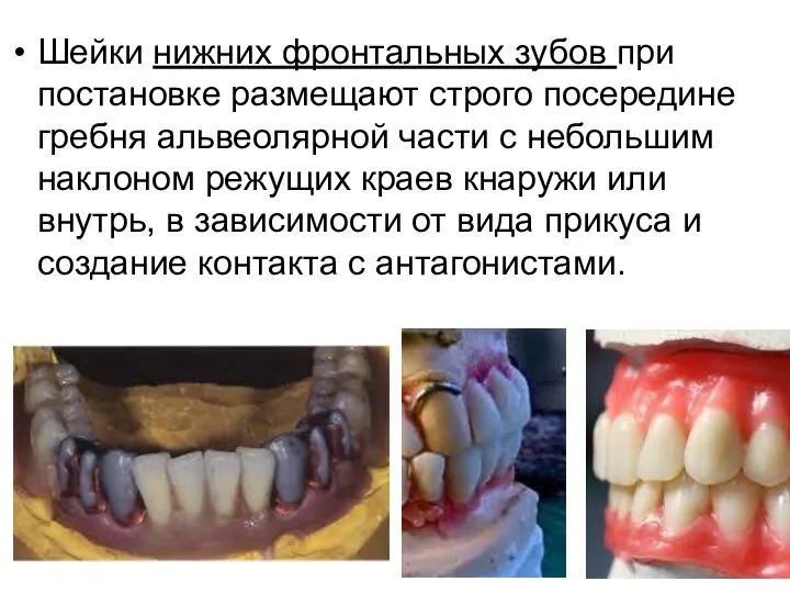 Шейки нижних фронтальных зубов при постановке размещают строго посередине гребня альвеолярной части
