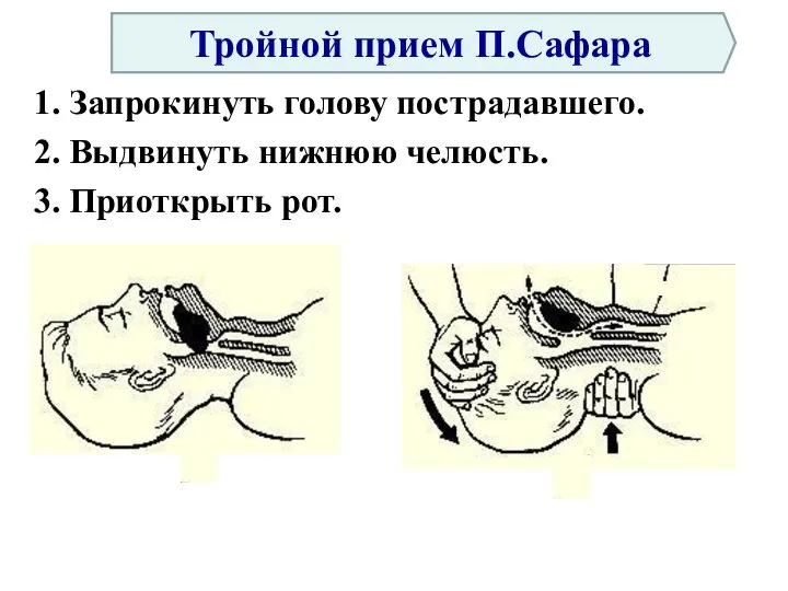 1. Запрокинуть голову пострадавшего. 2. Выдвинуть нижнюю челюсть. 3. Приоткрыть рот. Тройной прием П.Сафара