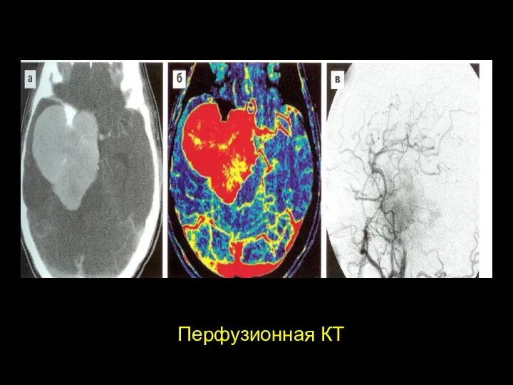 Перфузионная КТ