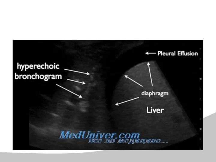 Прицельное УЗИ легкого