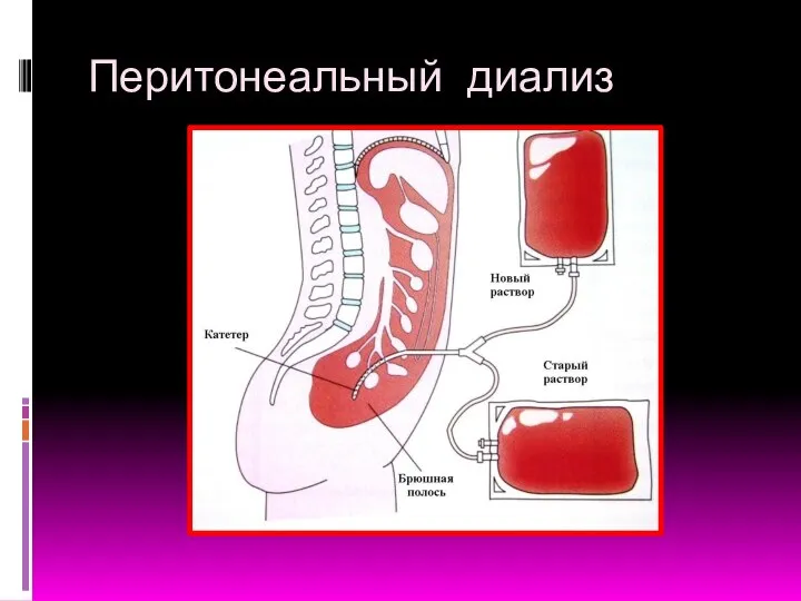 Перитонеальный диализ