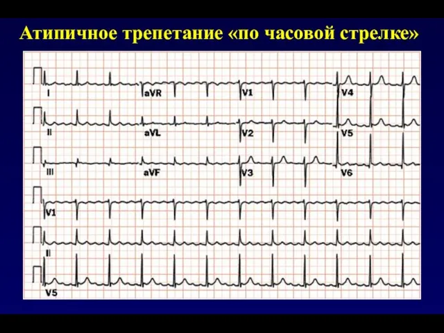 Атипичное трепетание «по часовой стрелке»