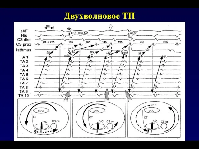 Двухволновое ТП