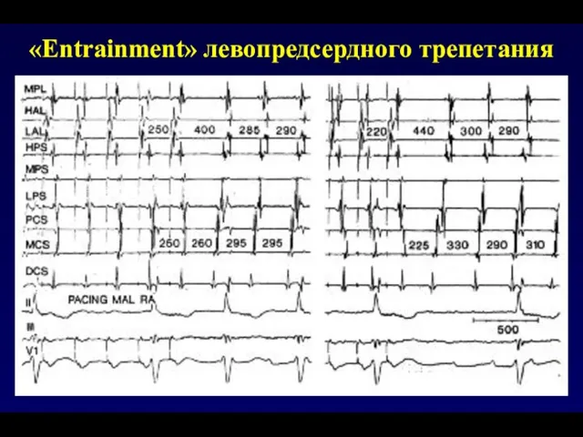 «Еntrainment» левопредсердного трепетания