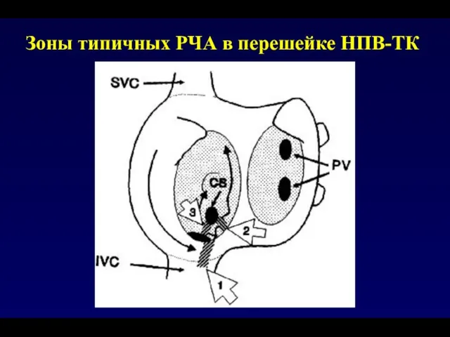 Зоны типичных РЧА в перешейке НПВ-ТК