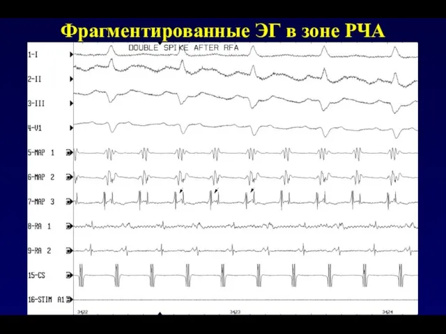 Фрагментированные ЭГ в зоне РЧА