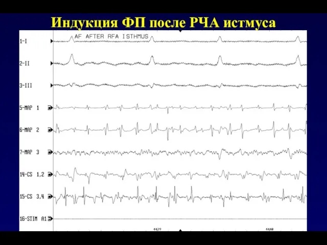 Индукция ФП после РЧА истмуса