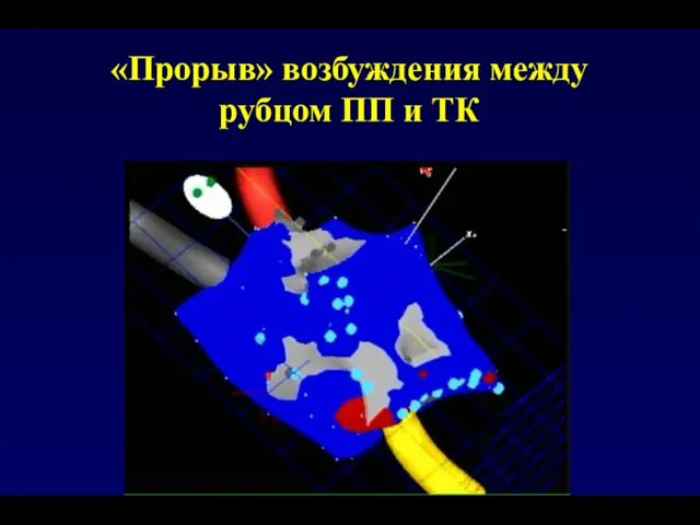 «Прорыв» возбуждения между рубцом ПП и ТК