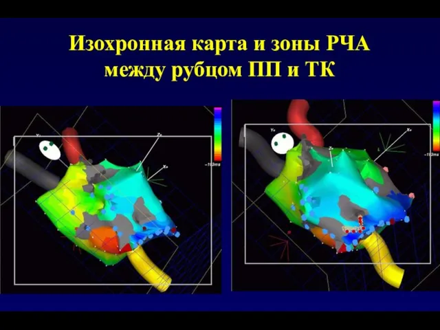 Изохронная карта и зоны РЧА между рубцом ПП и ТК