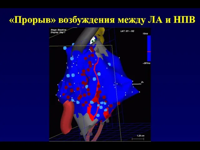 «Прорыв» возбуждения между ЛА и НПВ