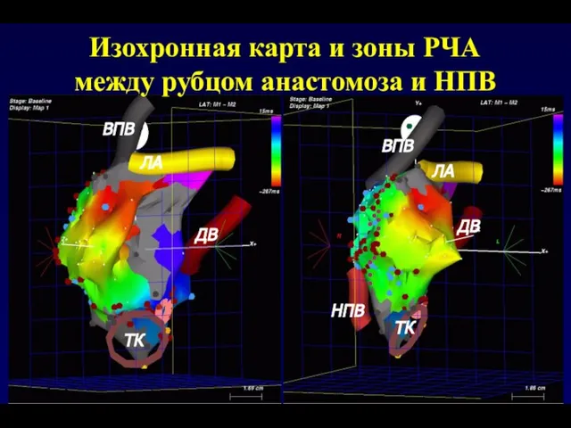 Изохронная карта и зоны РЧА между рубцом анастомоза и НПВ