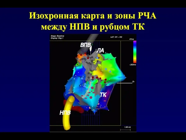 Изохронная карта и зоны РЧА между НПВ и рубцом ТК НПВ ЛА ВПВ ТК