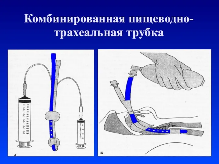 Комбинированная пищеводно-трахеальная трубка