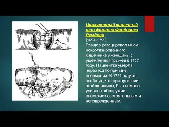 Циркулярный кишечный шов Филиппа Фредерика Рамдора (1694-1755) Рамдор резецировал 60 см некротизированного