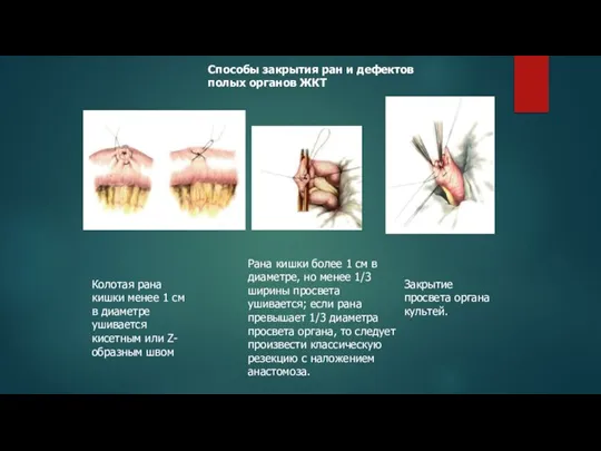 Способы закрытия ран и дефектов полых органов ЖКТ Колотая рана кишки менее