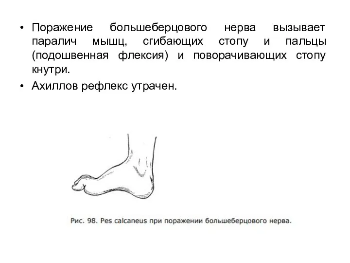 Поражение большеберцового нерва вызывает паралич мышц, сгибающих стопу и пальцы (подошвенная флексия)