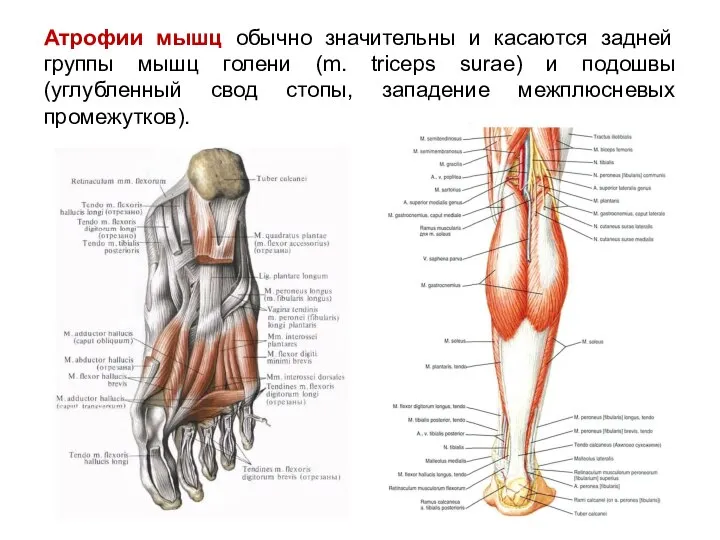 Атрофии мышц обычно значительны и касаются задней группы мышц голени (m. triceps