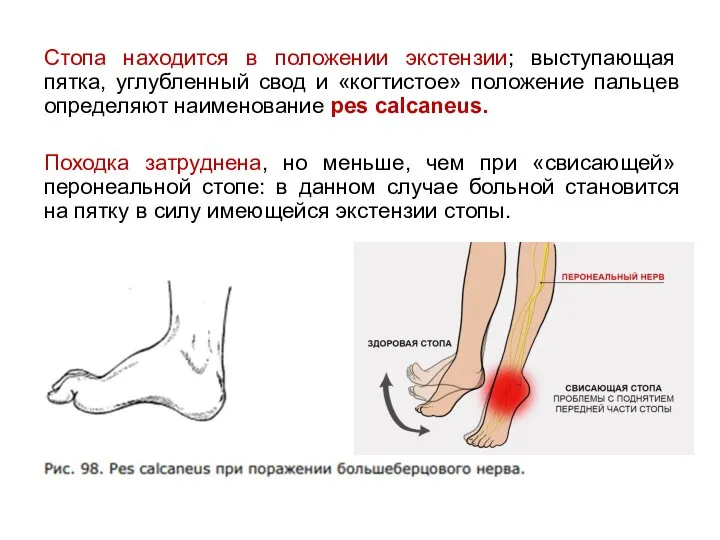 Стопа находится в положении экстензии; выступающая пятка, углубленный свод и «когтистое» положение