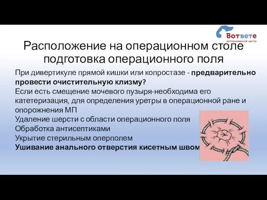 Расположение на операционном столе подготовка операционного поля При дивертикуле прямой кишки или