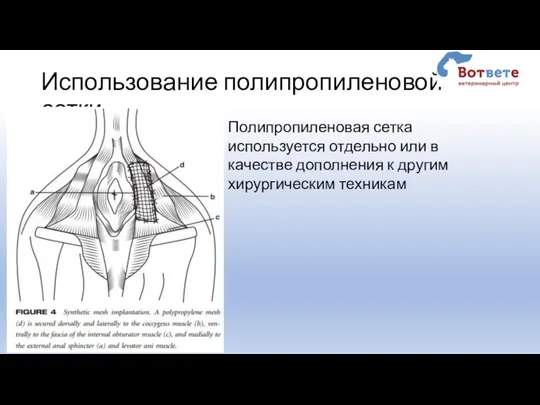 Использование полипропиленовой сетки Полипропиленовая сетка используется отдельно или в качестве дополнения к другим хирургическим техникам