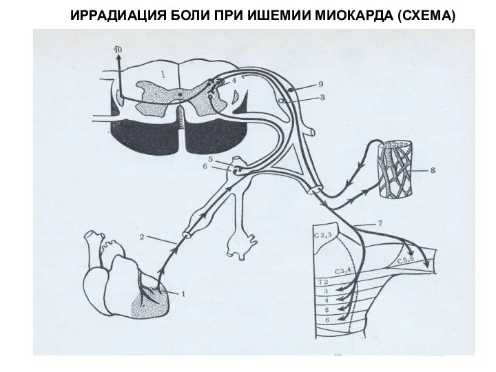 ИРРАДИАЦИЯ БОЛИ ПРИ ИШЕМИИ МИОКАРДА (СХЕМА)