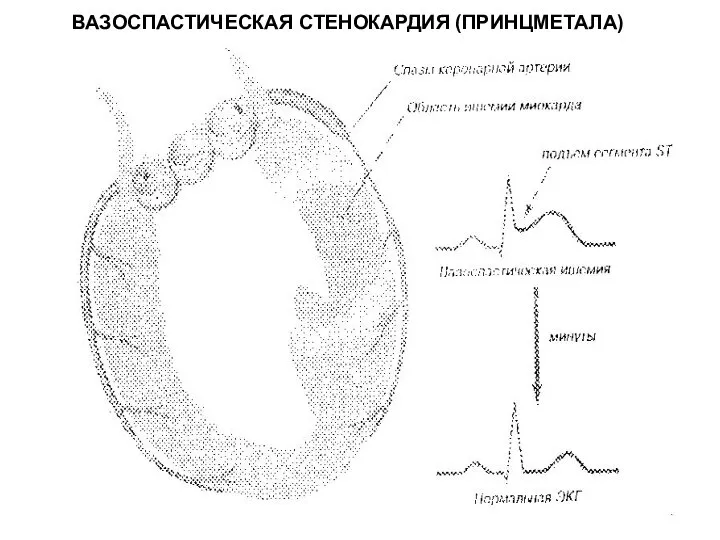 ВАЗОСПАСТИЧЕСКАЯ СТЕНОКАРДИЯ (ПРИНЦМЕТАЛА)