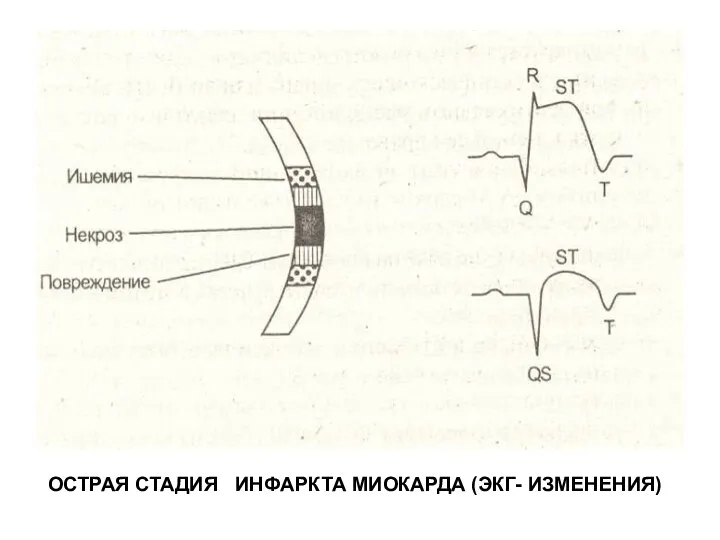 ОСТРАЯ СТАДИЯ ИНФАРКТА МИОКАРДА (ЭКГ- ИЗМЕНЕНИЯ)