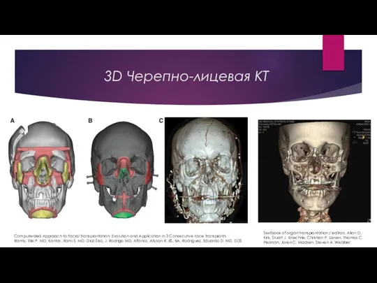 3D Черепно-лицевая КТ Computerized Approach to Facial Transplantation: Evolution and Application in