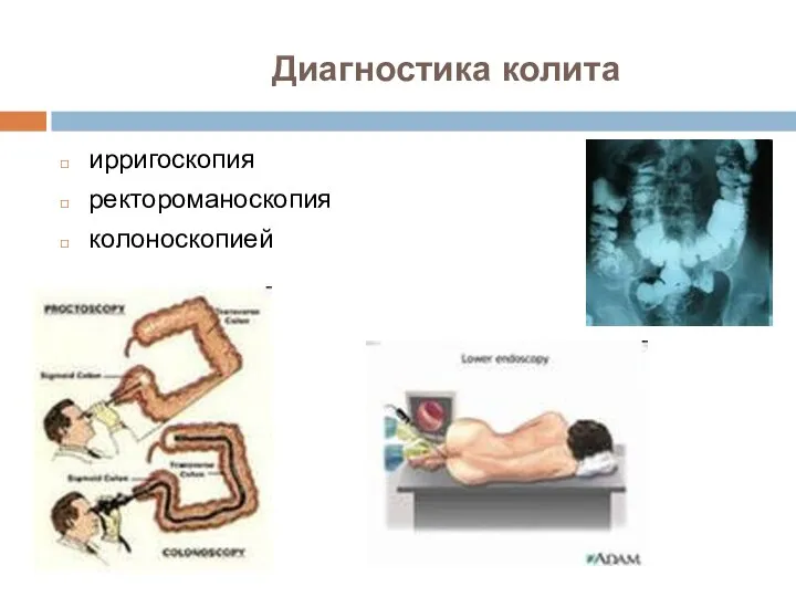 Диагностика колита ирригоскопия ректороманоскопия колоноскопией