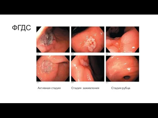 ФГДС Активная стадия Стадия заживления Стадия рубца