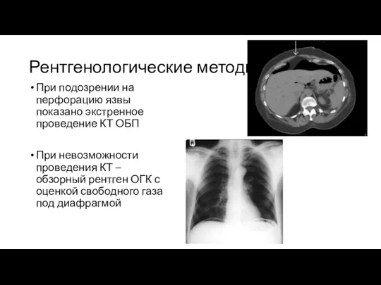 Рентгенологические методы При подозрении на перфорацию язвы показано экстренное проведение КТ ОБП