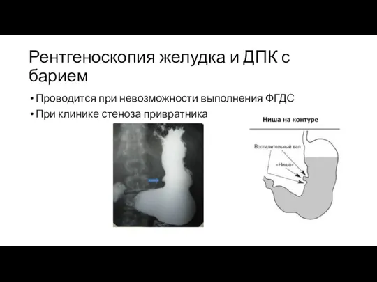 Рентгеноскопия желудка и ДПК с барием Проводится при невозможности выполнения ФГДС При клинике стеноза привратника