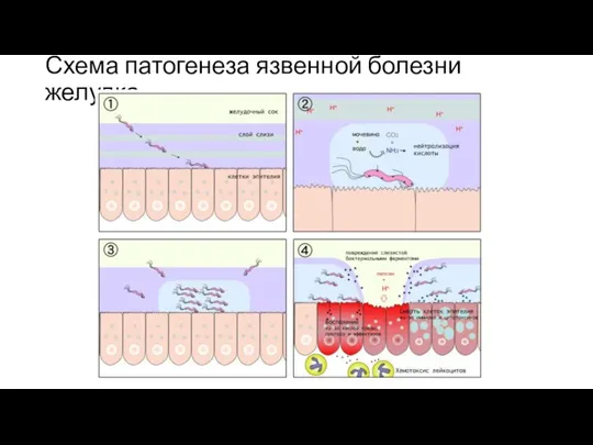 Схема патогенеза язвенной болезни желудка