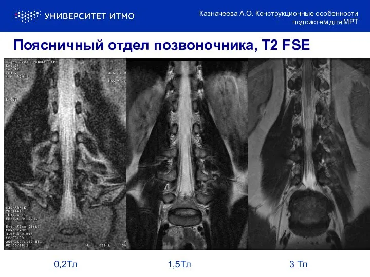 0,2Тл 1,5Тл 3 Тл Поясничный отдел позвоночника, T2 FSE Казначеева А.О. Конструкционные особенности подсистем для МРТ