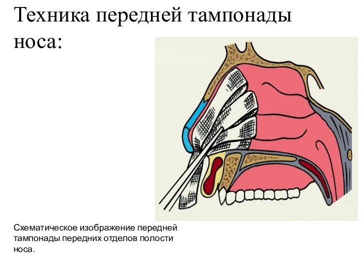 Схематическое изображение передней тампонады передних отделов полости носа. Техника передней тампонады носа: