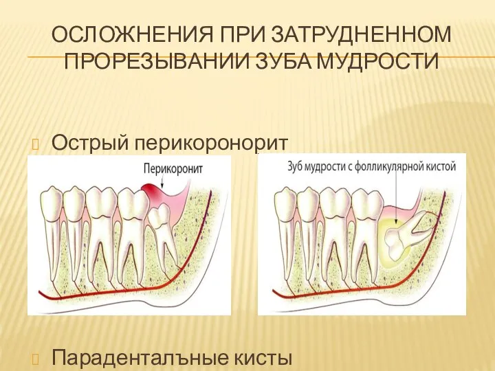 ОСЛОЖНЕНИЯ ПРИ ЗАТРУДНЕННОМ ПРОРЕЗЫВАНИИ ЗУБА МУДРОСТИ Острый перикоронорит Параденталъные кисты