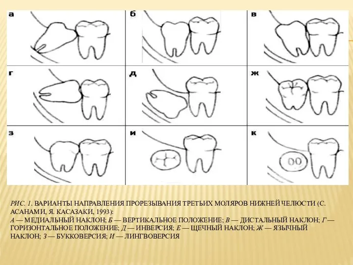 РИС. 1. ВАРИАНТЫ НАПРАВЛЕНИЯ ПРОРЕЗЫВАНИЯ ТРЕТЬИХ МОЛЯРОВ НИЖНЕЙ ЧЕЛЮСТИ (С. АСАНАМИ, Я.