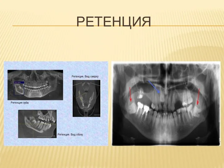 РЕТЕНЦИЯ