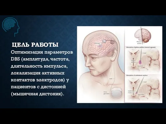 ЦЕЛЬ РАБОТЫ Оптимизация параметров DBS (амплитуда, частота, длительность импульса, локализация активных контактов