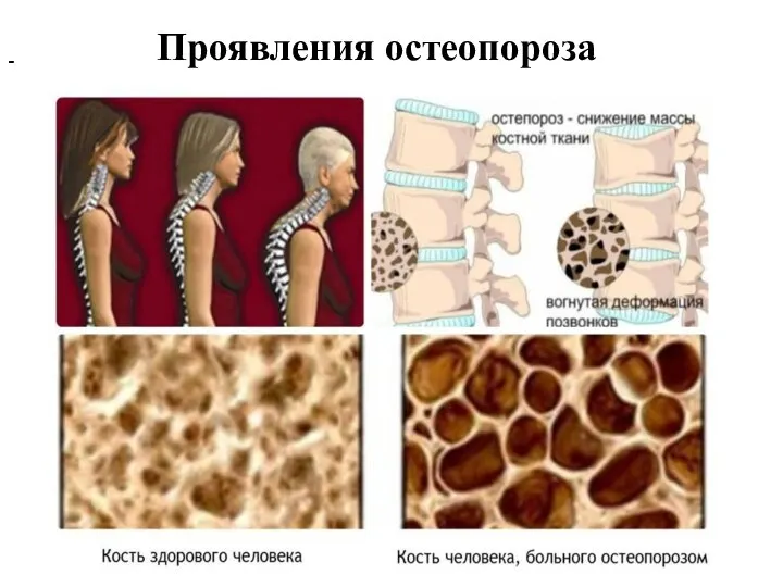 - Проявления остеопороза