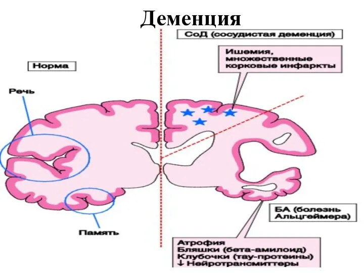 Деменция