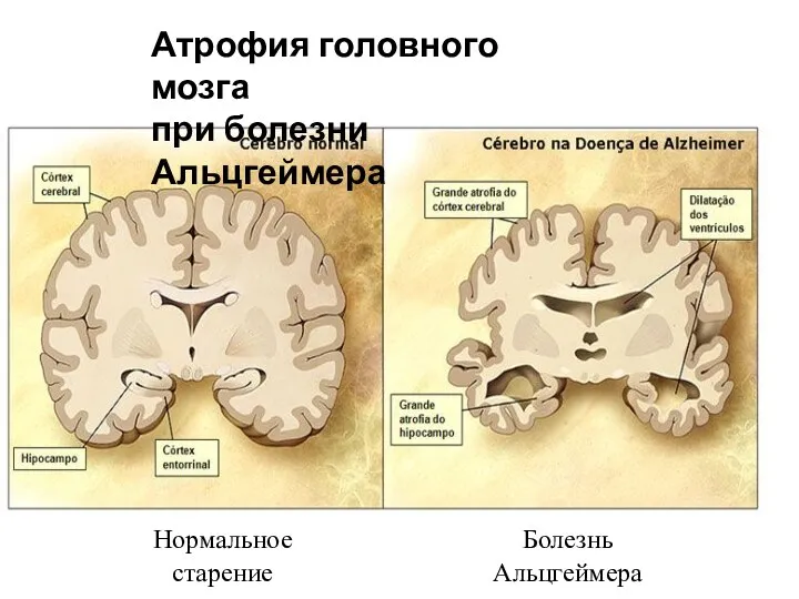 Болезнь Альцгеймера Нормальное старение Атрофия головного мозга при болезни Альцгеймера