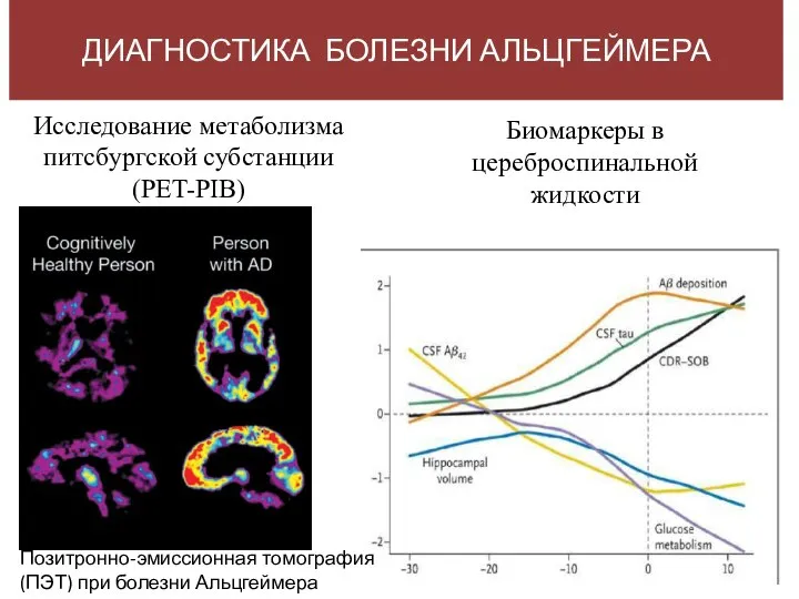 Исследование метаболизма питсбургской субстанции (PET-PIB) ДИАГНОСТИКА БОЛЕЗНИ АЛЬЦГЕЙМЕРА Биомаркеры в цереброспинальной жидкости