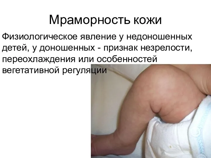 Мраморность кожи Физиологическое явление у недоношенных детей, у доношенных - признак незрелости,
